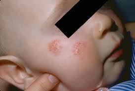Penyakit Kulit Dermatitis Atopik