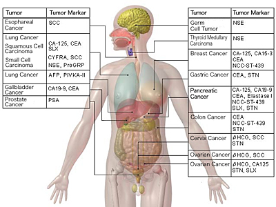 Sindrom Tumor Karsinoid