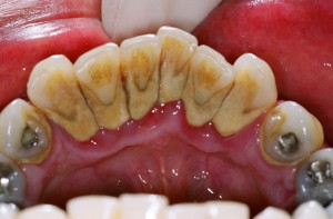Tips Cara Membersihkan Karang Gigi Dalam Mulut