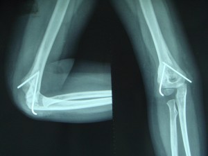Osteomalasia Mengacu Pada Pelunakan Tulang