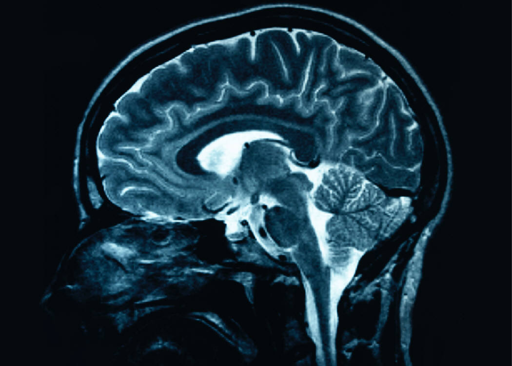 Parkinson Merupakan Penyakit Menyerang Otak Manusia