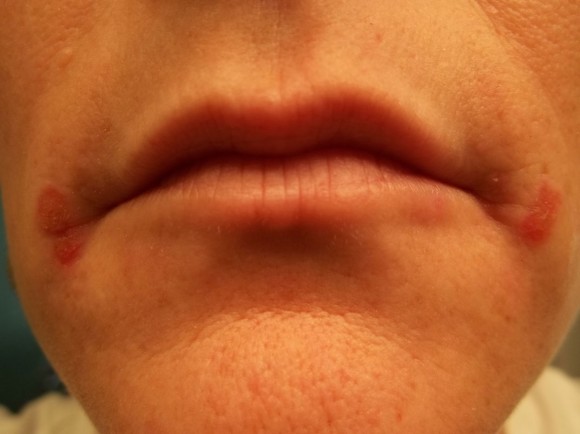 Penyakit bibir pecah-pecah Angular Cheilitis