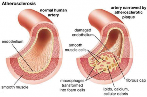 Penyakit Atherosclerosis Jantung