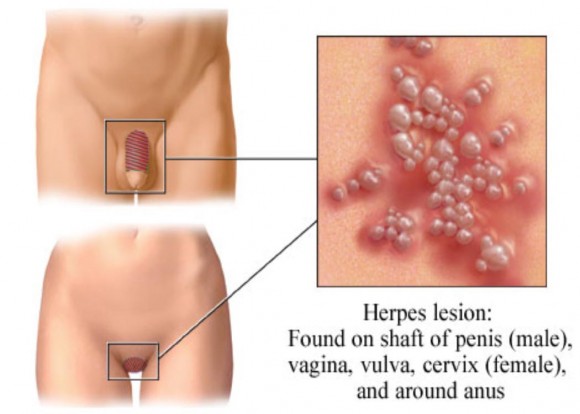 Penyakit Kelamin Herpes Genitalis