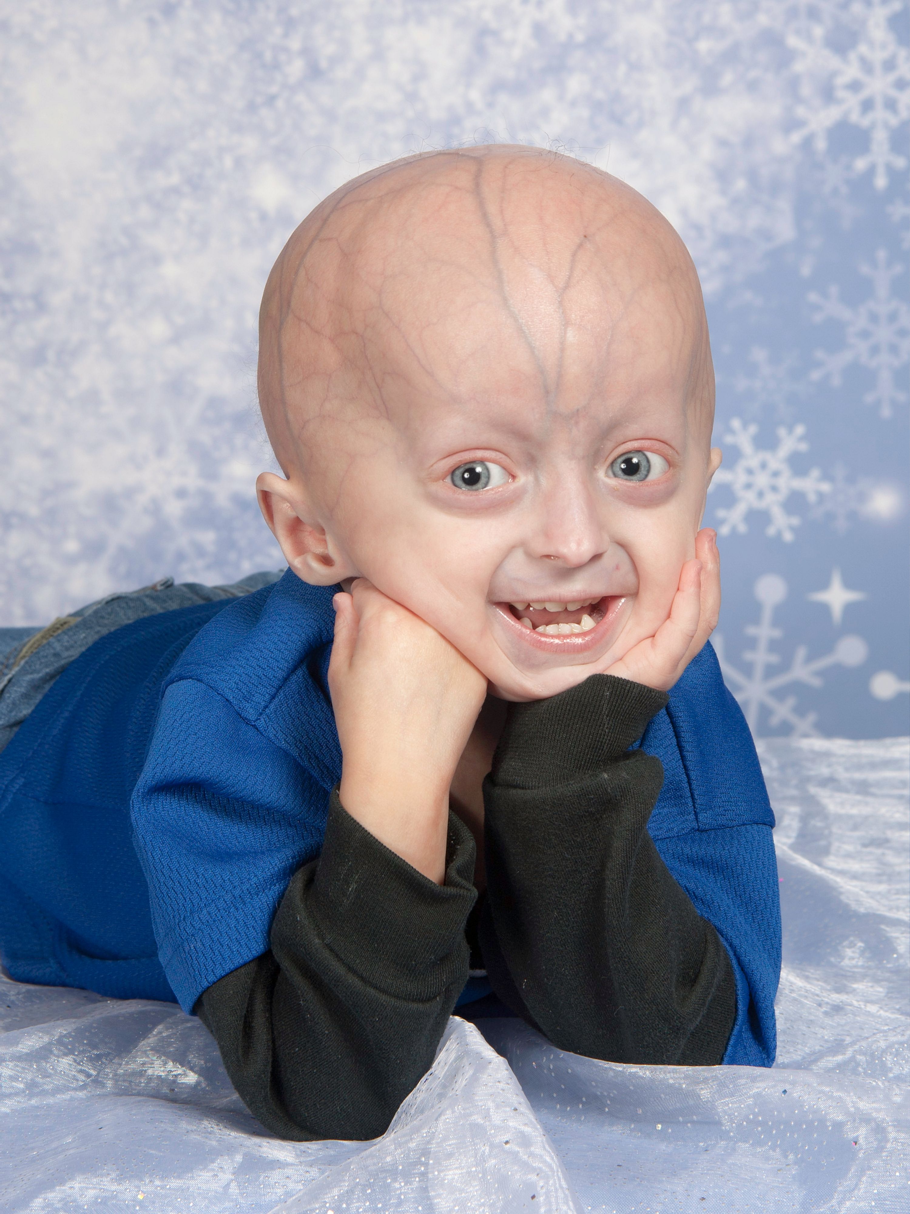 Penyakit Progeria Adalah Penyakit Langka Di Dunia