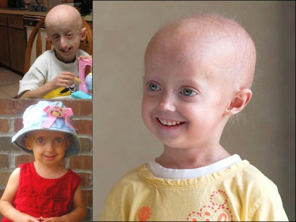 Penyakit Progeria Adalah Penyakit Langka Di Dunia