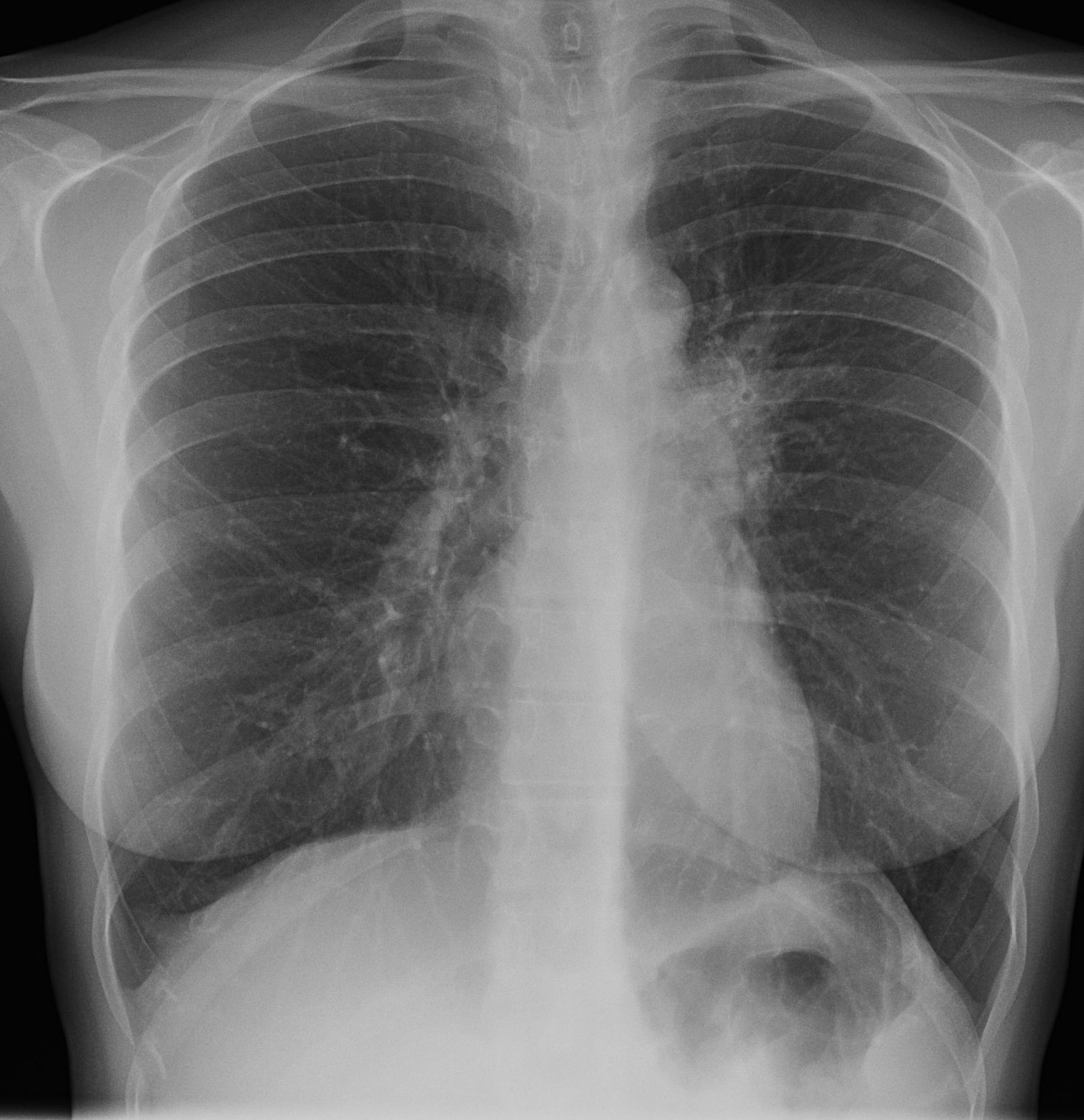 Penyakit Tuberkulosis (TBC) Menyerang Siapa Saja