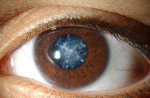 Lensa Mata Rusak Minimbulkan Penyakit Katarak Mata