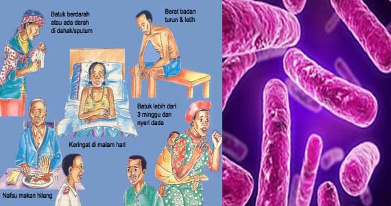 Penyakit TBC Harus Memerlukan Penanganan Khusus