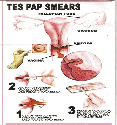 Lakukan Tes Pap Smear Untuk Memeriksa Vagina Aman