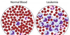 Leukemia Limfositik Akut