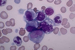 Informasi Penyakit Leukemia Mieloid Akut