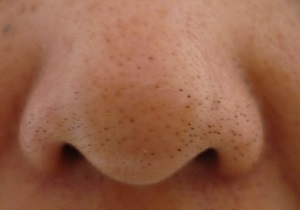 Tips dan Cara Menghilangkan Komedo di Hidung