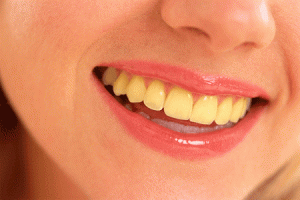 Tips Memutihkan Gigi Kuning Secara Alami