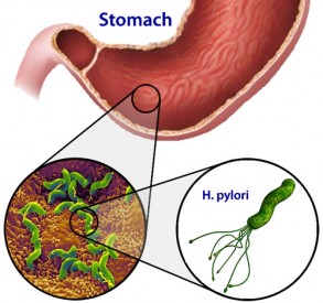 Infeksi Helicobacter Pylori Pada Lambung Manusia