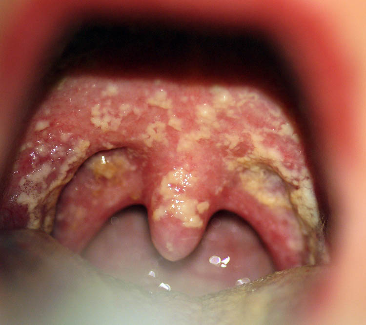 Infeksi di Dalam Rongga Mulut