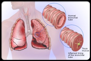 Penyakit Bronkitis dan Penyakit Asma
