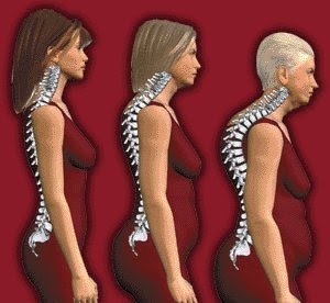 Informasi Penyakit Osteoporosis